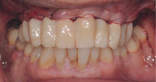 maxilla teljes rehabilitációja