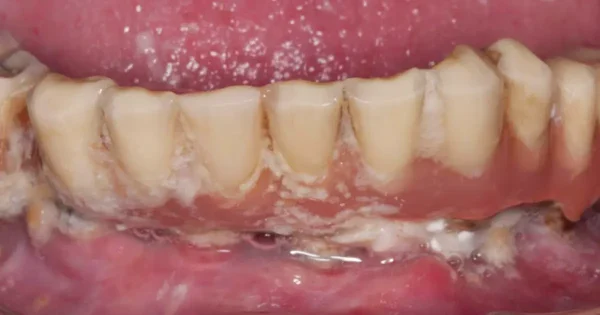 periimplantitis nem sebészi úton