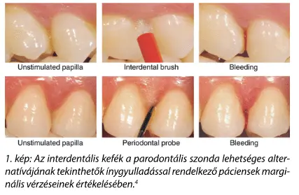 Fogköztisztítás felsőfokon
