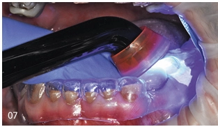 Amelogenesis imperfectával diagnosztizált